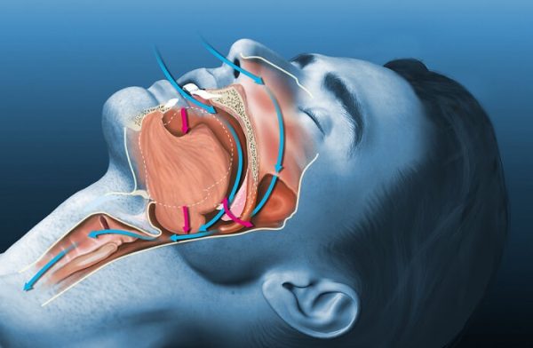 Cơ chế tắc nghẽn đường thở gây ngưng thở khi ngủ và giảm oxy máu