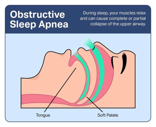 Vì Sao Nên Dùng Máy CPAP Trước Khi Phẫu Thuật OSA? 4 Minh họa tình trạng ngưng thở khi ngủ do tắc nghẽn OSA khi đường thở bị hẹp trong lúc ngủ