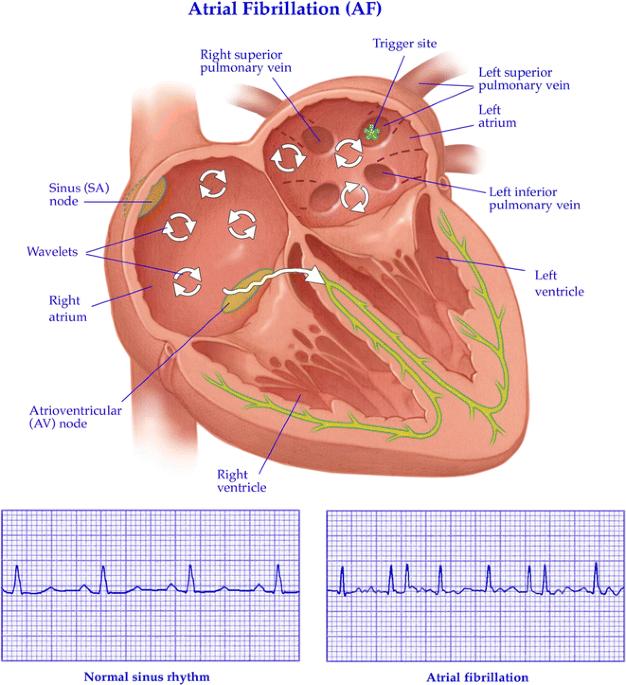 Mối liên hệ giữa ngưng thở khi ngủ và rung nhĩ