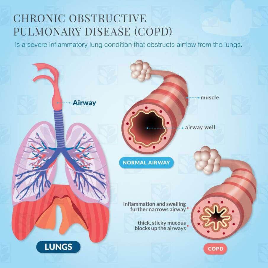 Người bệnh COPD giữ CO₂ khi ngủ: Máy Lumis hỗ trợ ra sao? 3 Tình trạng giảm thông khí về đêm ở người bệnh COPD cần được đánh giá dựa trên triệu chứng, bệnh nền và các xét nghiệm phù hợp. Chỉ số SpO₂ giúp theo dõi độ bão hòa oxy nhưng không đo trực tiếp CO₂ trong máu; khi nghi ngờ tăng CO₂, bác sĩ có thể chỉ định đánh giá khí máu hoặc phương pháp cần thiết khác.