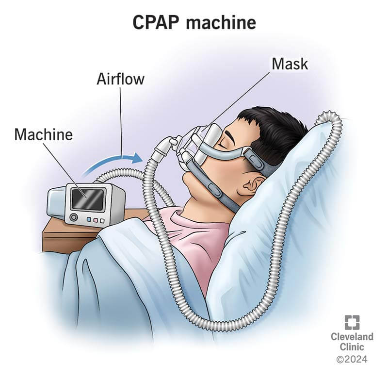 Máy Trợ Thở Có Phù Hợp Với Mọi Đối Tượng Bị Ngưng Thở Khi Ngủ? 4 Hiệu quả điều trị ngưng thở khi ngủ phụ thuộc lớn vào sự thoải mái, độ kín của mặt nạ và khả năng dung nạp áp lực của người bệnh.
